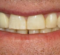 Granulom zuba – upala u korijenu