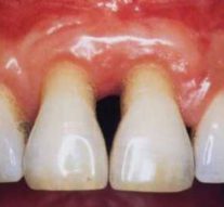 Parodontoza je jedna od najčešćih bolesti zuba